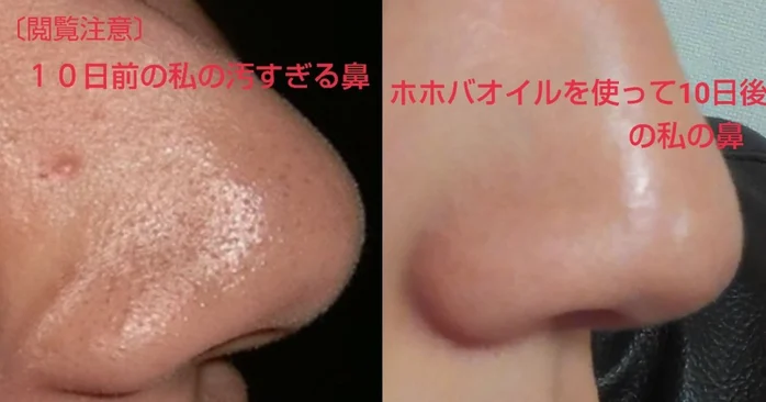 持续进行数次就发觉黑头慢慢被清出,鼻子就能像“白煮蛋”一样细嫩,看不到黑头粉刺和毛孔啦!