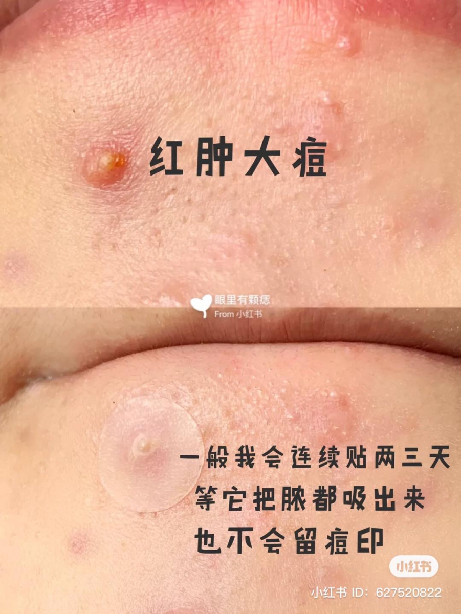 什么痘痘适合粘痘痘贴