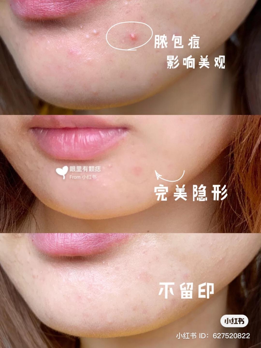 痘痘贴的正确使用步骤