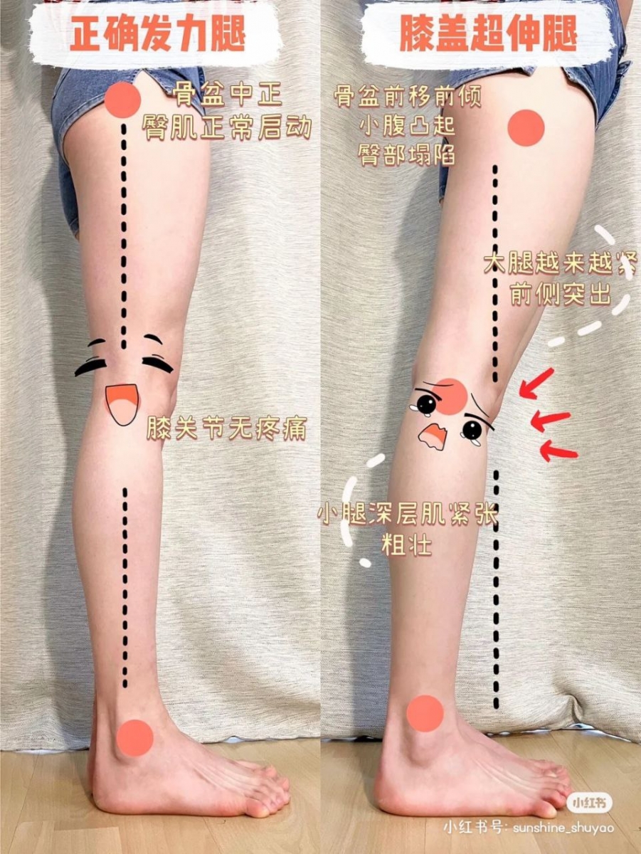 什么是「膝超伸」?