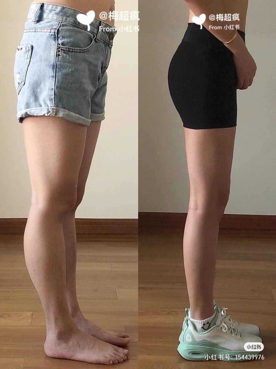 调整走路姿势,无痛矫正腿型!