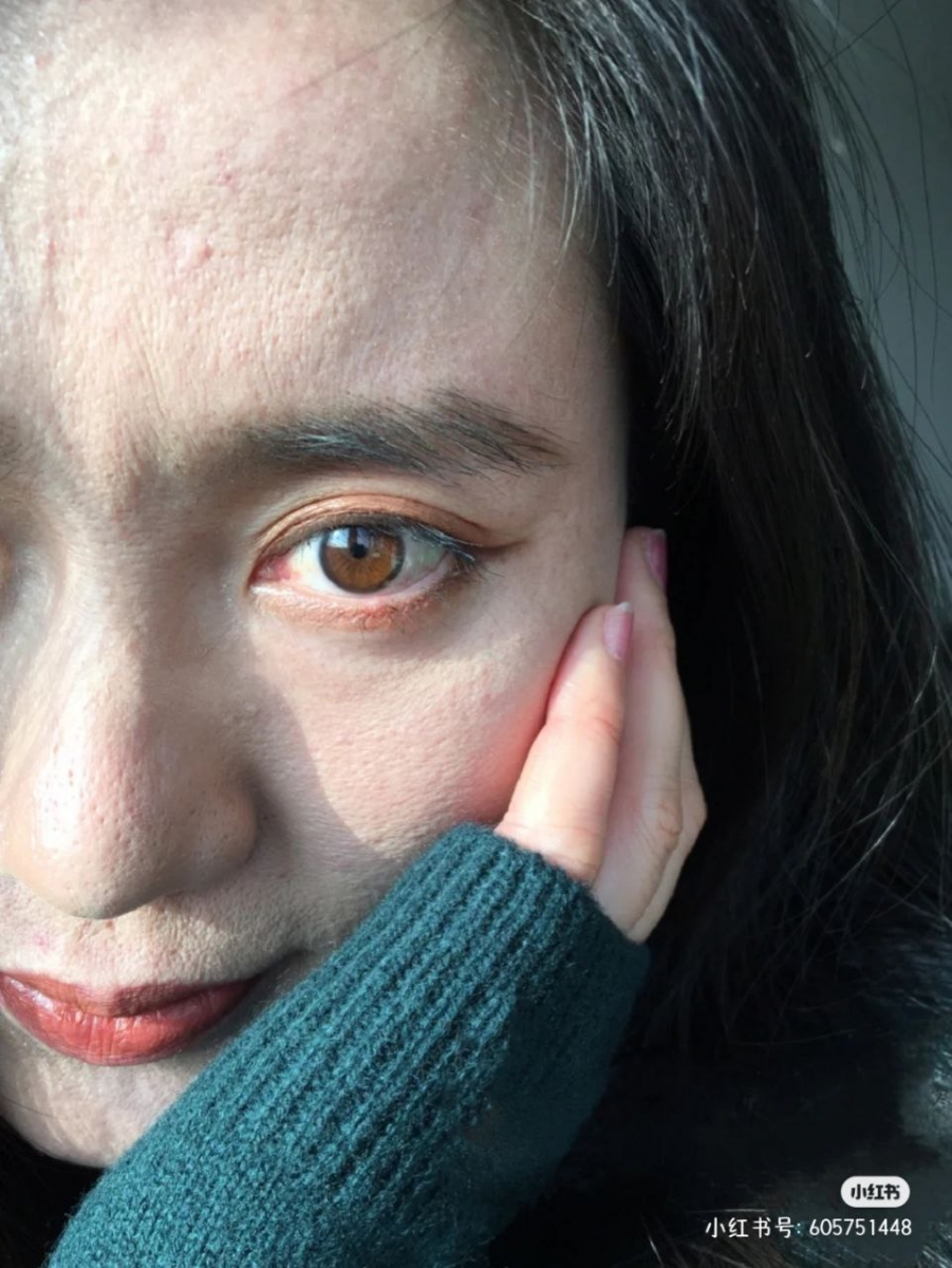 1、皮肤干燥老化