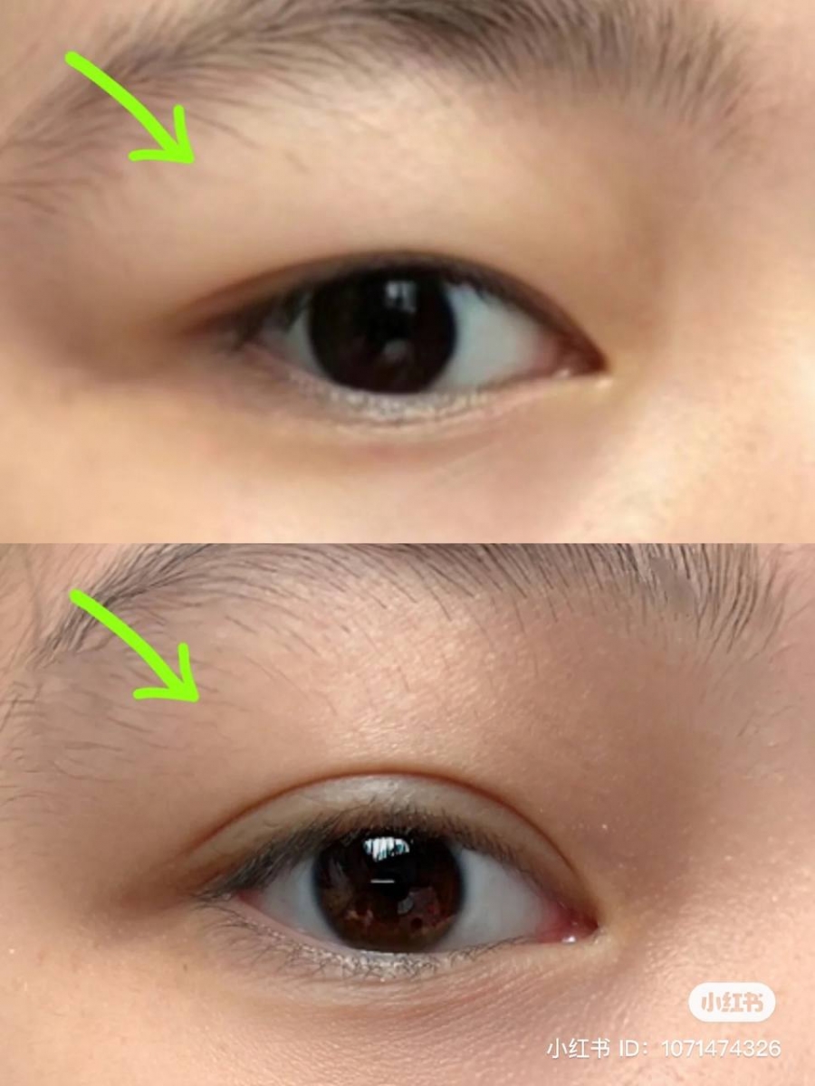 1、眼皮消肿 + 打造双眼皮