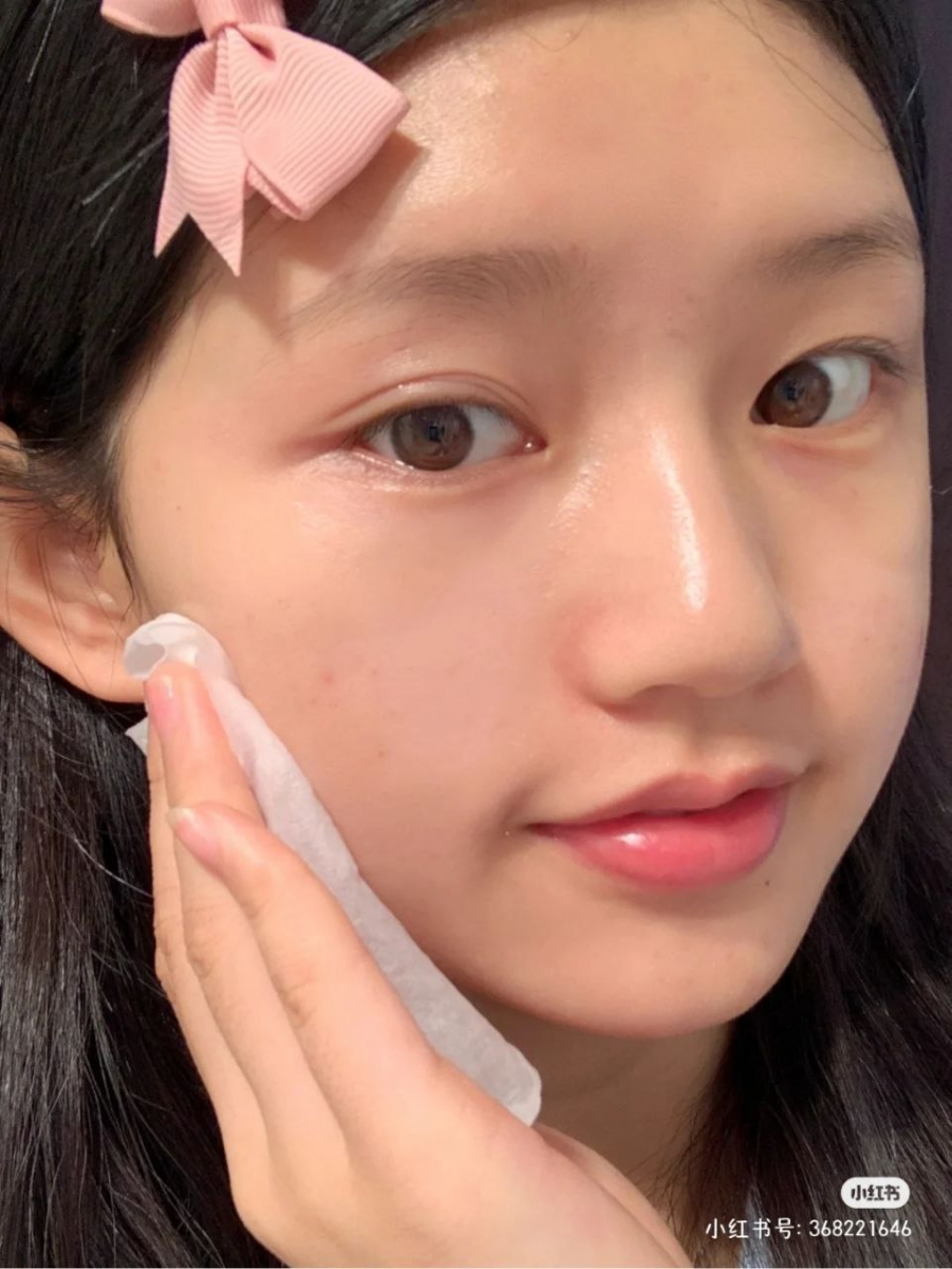 3、皮脂过度分泌