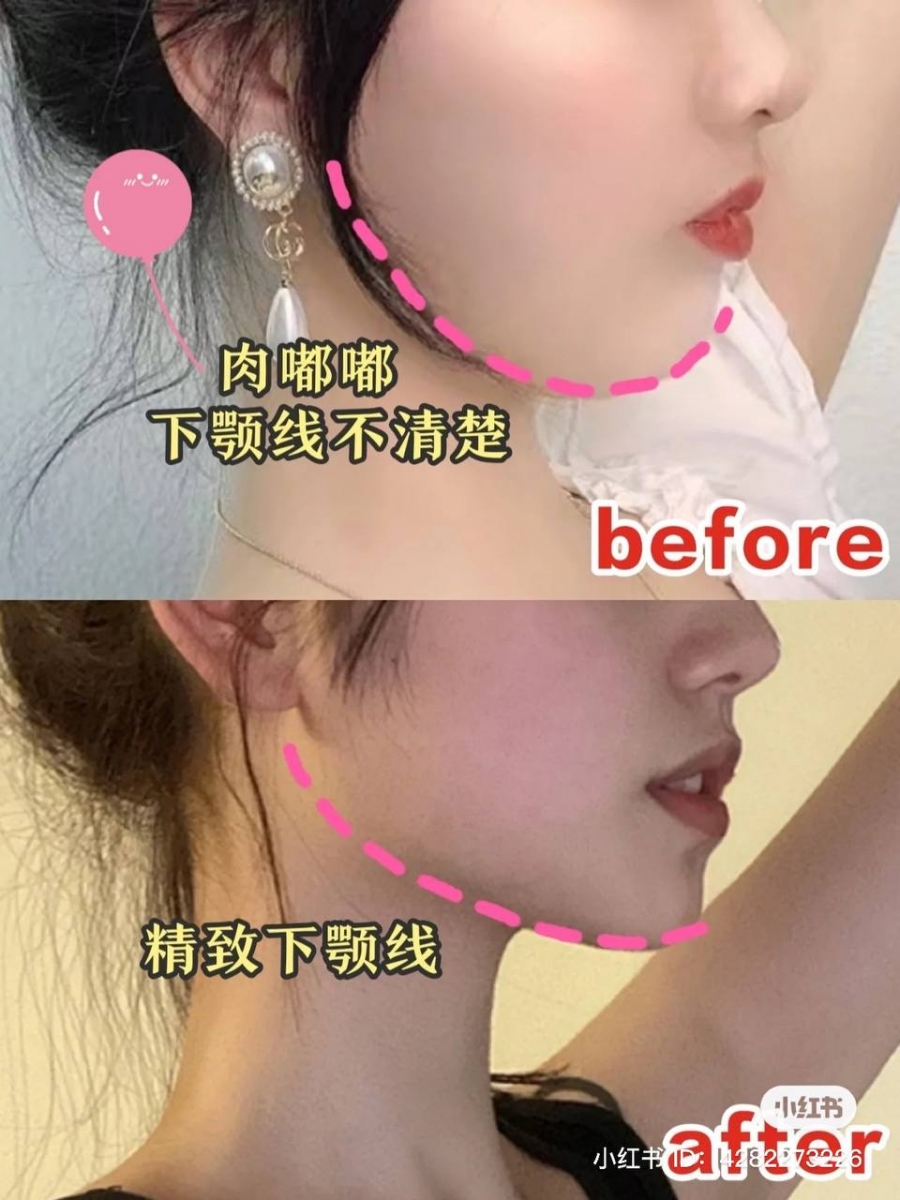 5、打造清晰下颌线