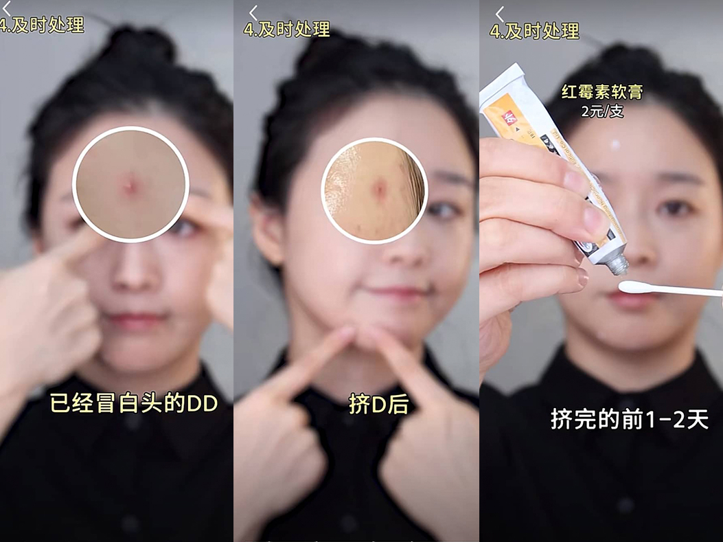 冒白头的痘痘、挤完痘痘后