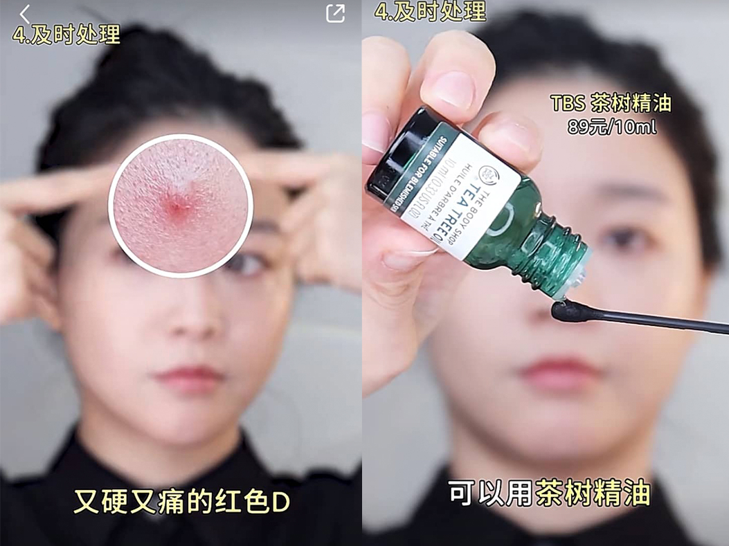 红肿硬块痘痘