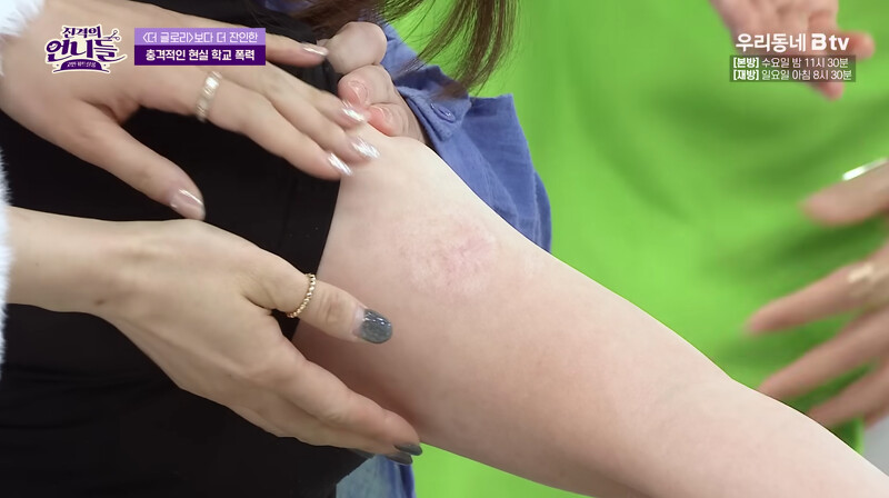 #留下难以磨灭的伤疤