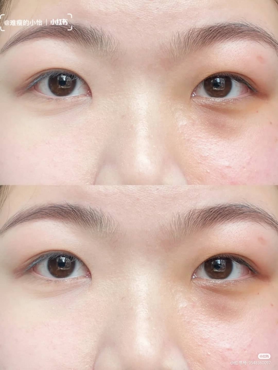 「重度黑眼圈遮瑕法」