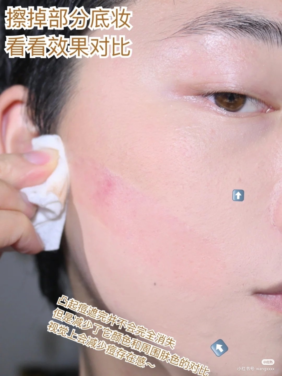 4种「痘痘遮瑕大法」