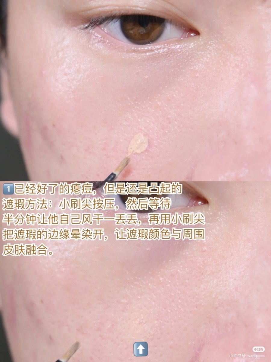 1、已经好了的瘪痘