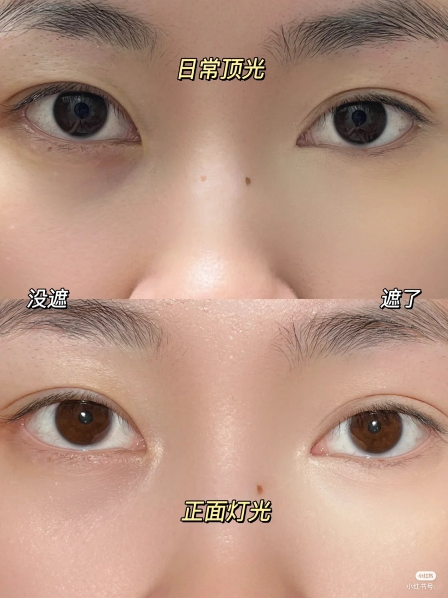 「黑眼圈泪沟消失术」教程