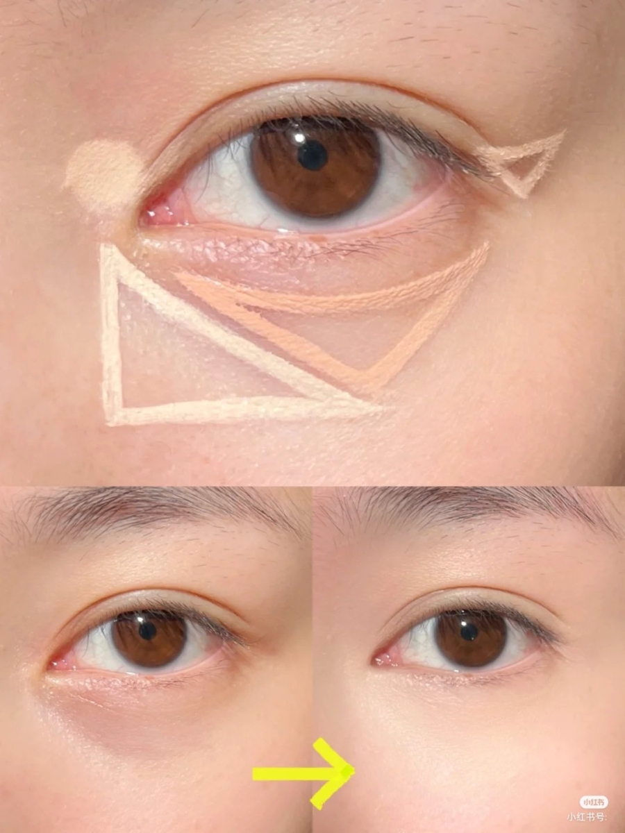 「黑眼圈泪沟消失术」教程