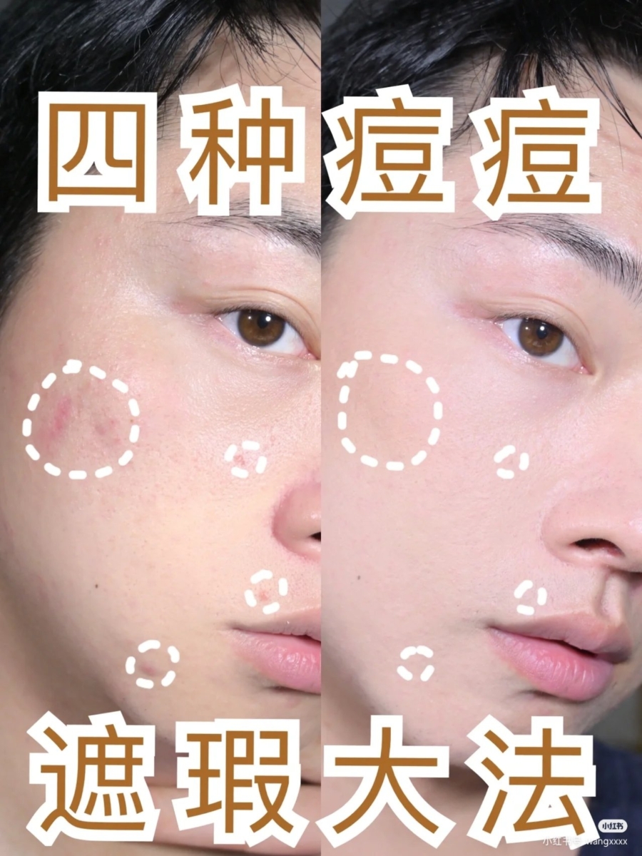 4种「痘痘遮瑕大法」