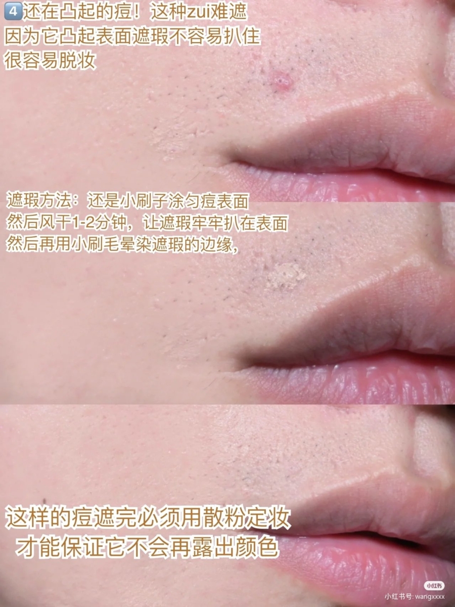 4、还在凸起的痘