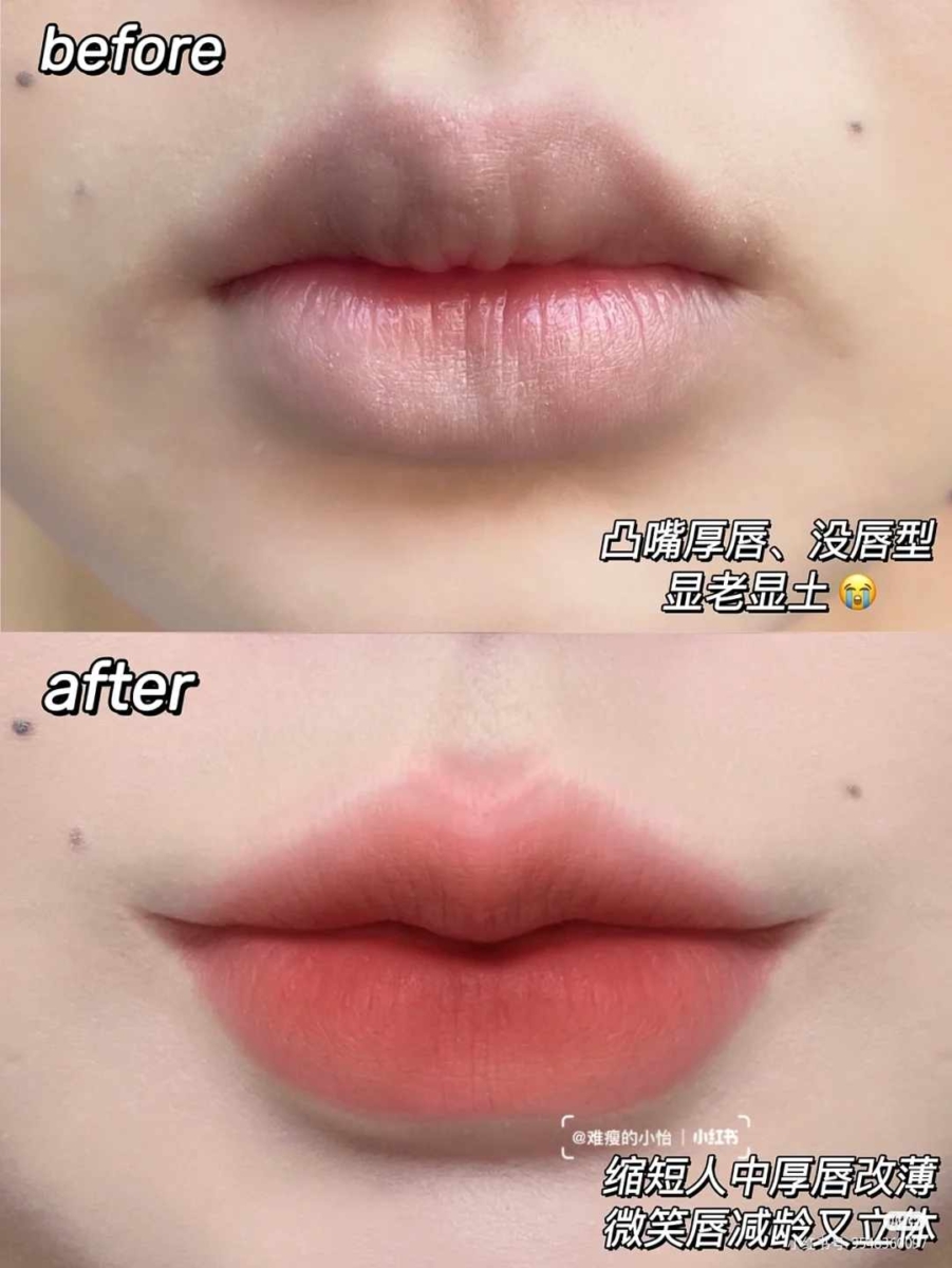 1、凸嘴厚唇变「微笑唇」