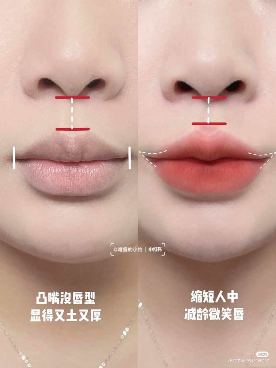 1、凸嘴厚唇变「微笑唇」