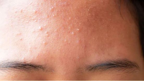 解决「闭口」的方法