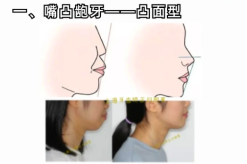 1、嘴凸龅牙 ——凸面型