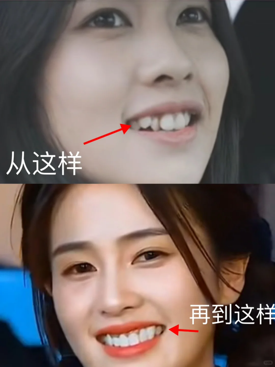 很多明星也做过牙齿矫正
