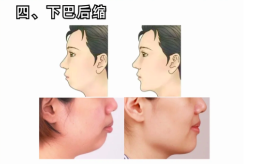 4、下巴后缩