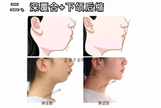 2、深覆合、下颌后缩