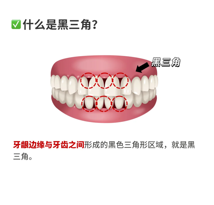 2)黑三角