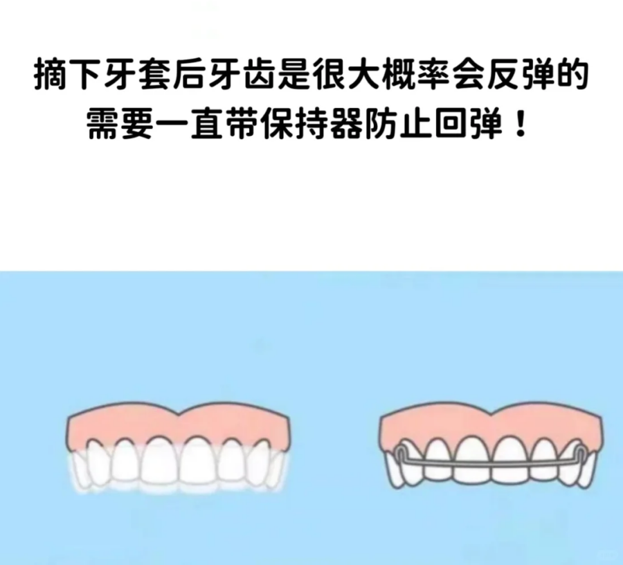 3)可能需要戴一辈子维持器