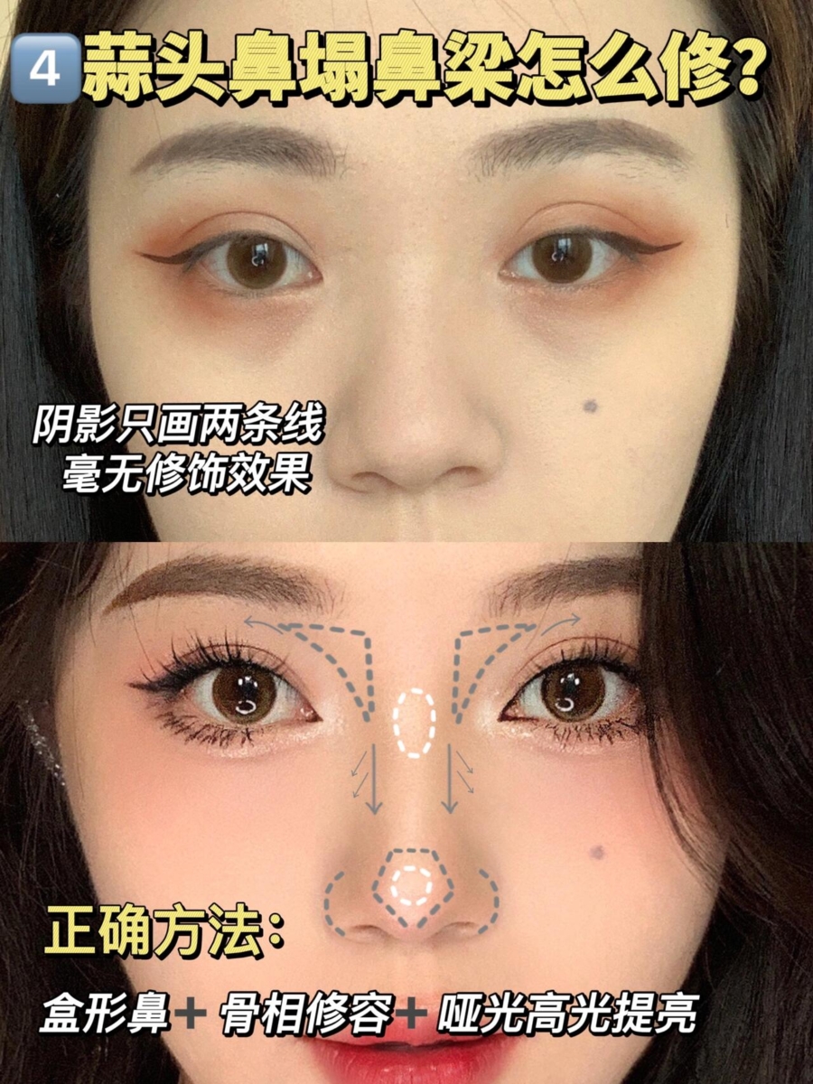 4、蒜头鼻塌鼻梁?