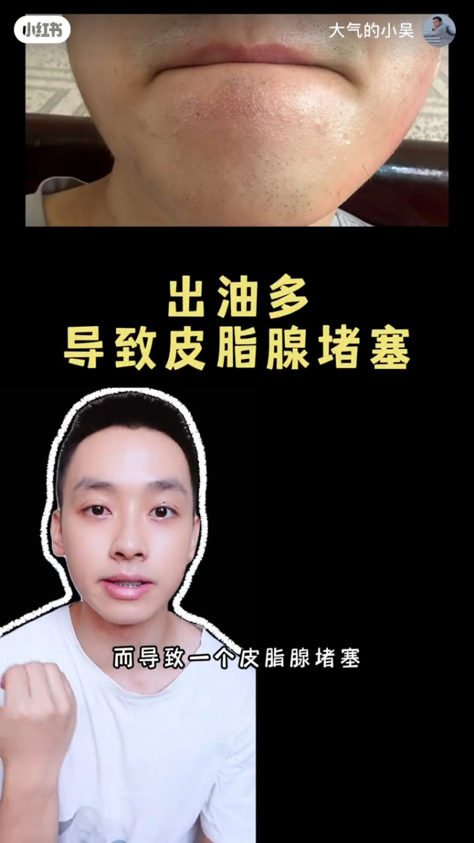 下巴小颗粒