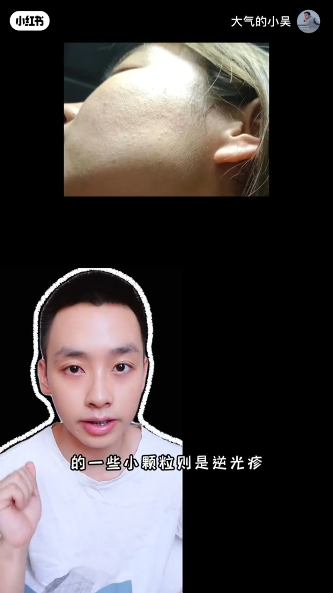 脸颊小颗粒