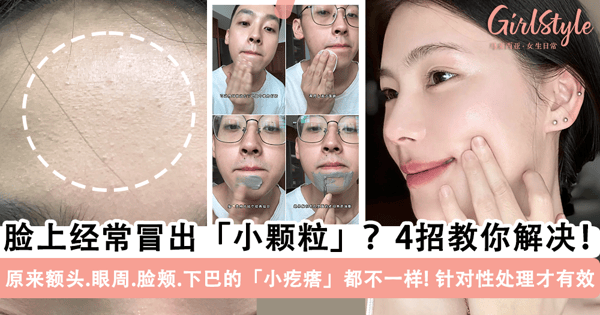脸上经常冒出「小颗粒」怎么办？4 种方式针对性解决「闭口粉刺、毛周角化、逆光疹」，7 天让肌肤像剥了壳的鸡蛋~