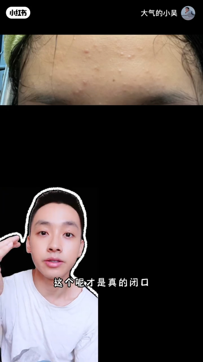 额头小颗粒