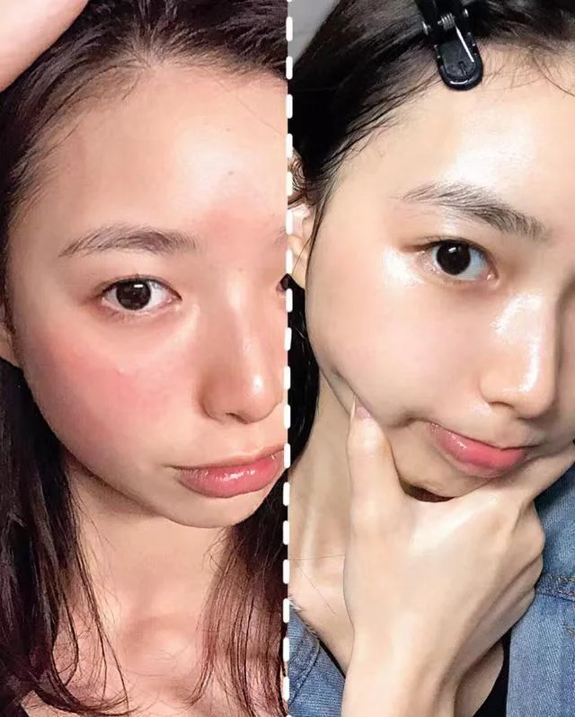 敏感肌是一种常见的皮肤问题