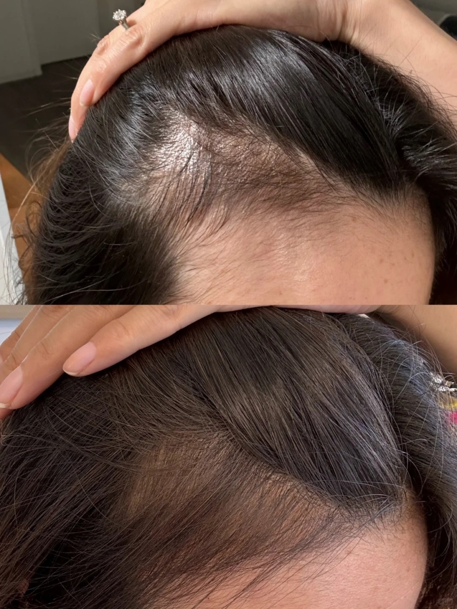 6、头皮可见度测试