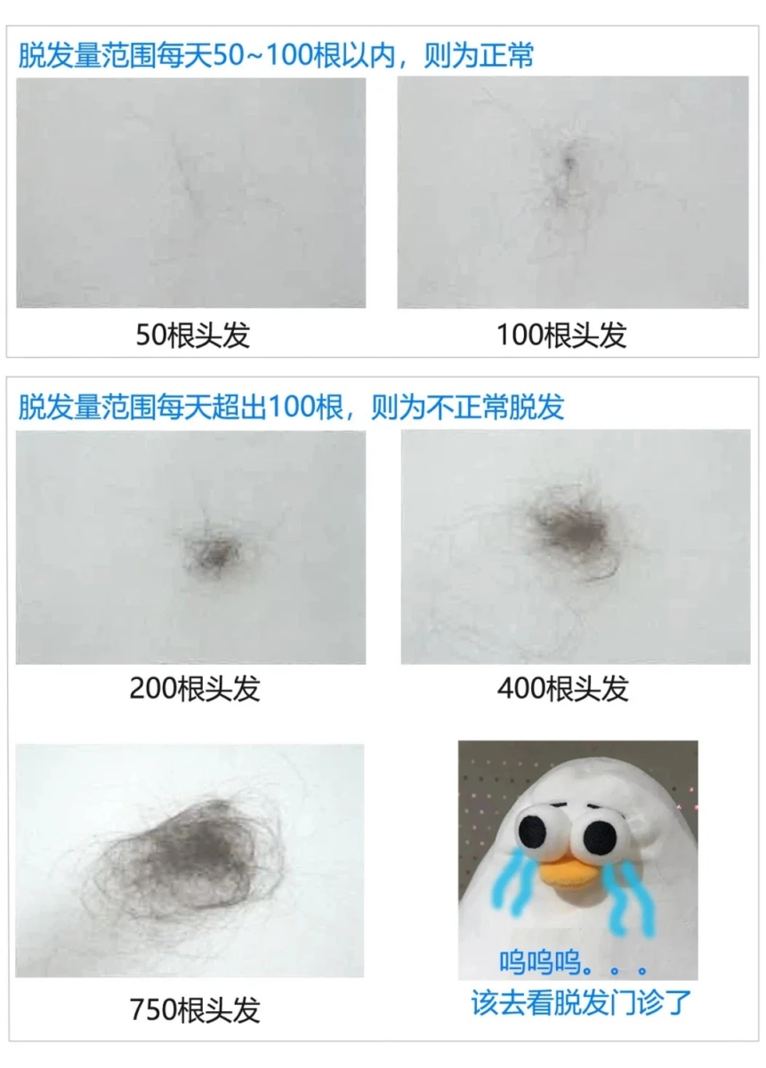 每天掉发超过 100-200 根需要关注脱发问题