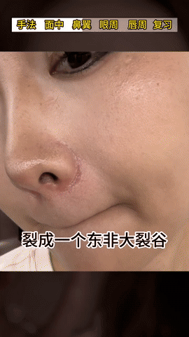 Step 3、鼻翼