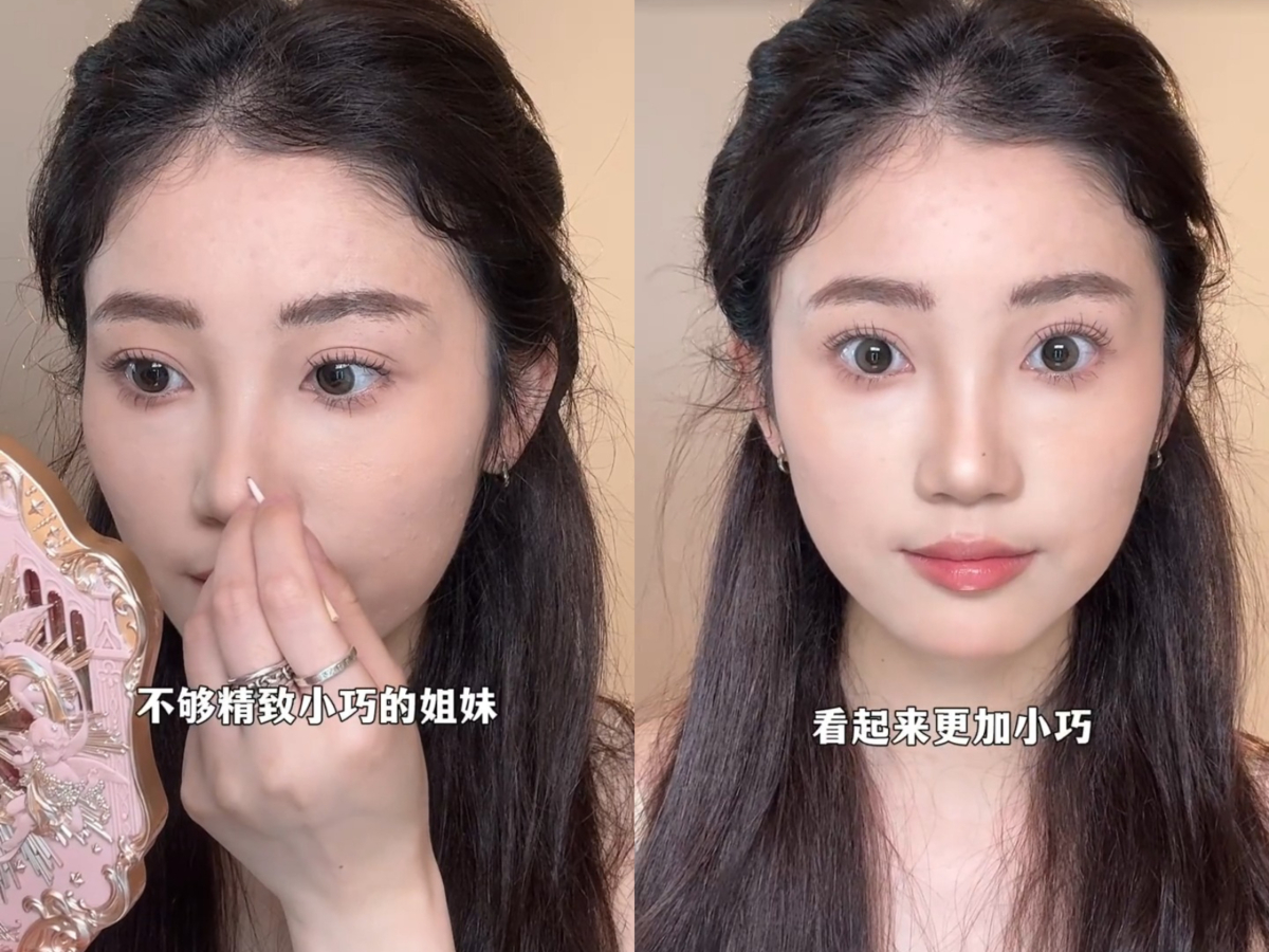 4、鼻尖痣