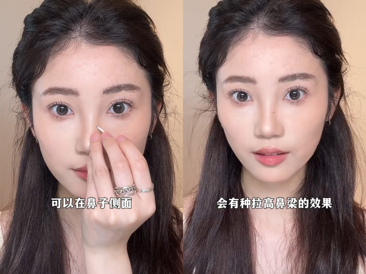 3、鼻梁痣
