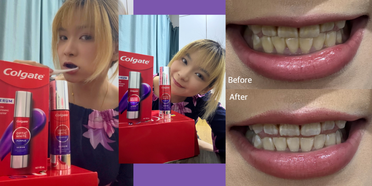 Chai Yun Vui 💜不用花大价钱就可以美白牙齿!
