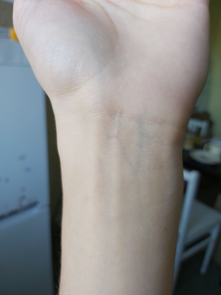 D. 静脉偏绿色或棕色