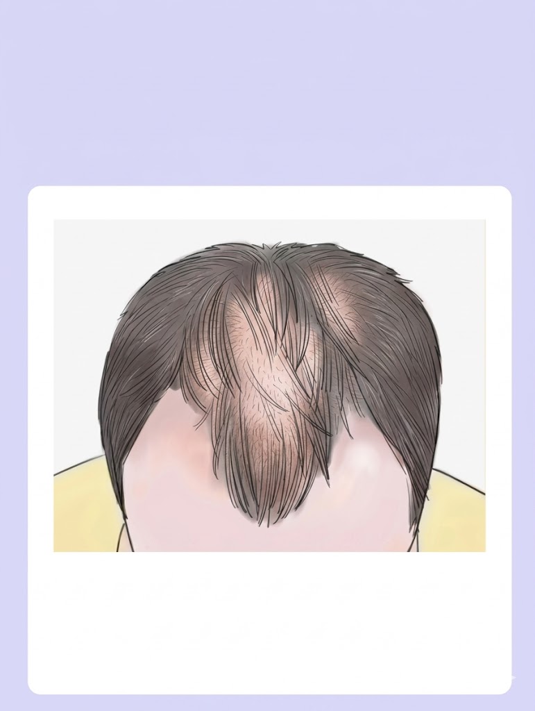 🎯 选 D 的你 👉 【4. U型发际线：少阳胆经的求救】