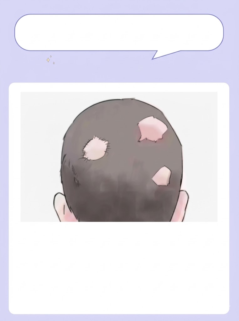 🎯 选 F 的你 👉 【6. 斑秃脱发：神秘的“鬼剃头”】