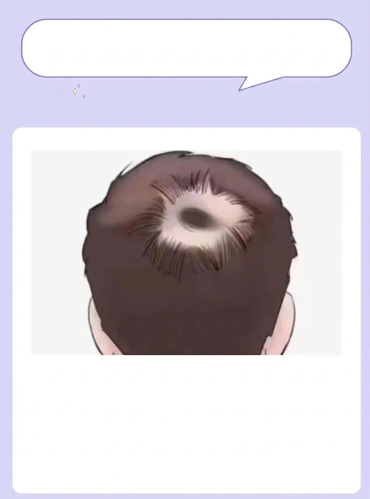 🎯 选 E 的你 👉 【5. 脂溢性脱发：青壮年的“头顶杀手”】