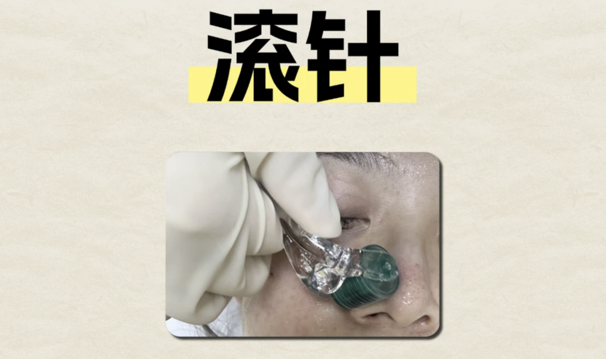 一、滚针：唤醒肌肤的“微创通道”