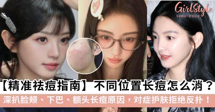 【精准祛痘指南】不同位置长痘怎么消？深扒脸颊、下巴、额头长痘原因，对症护肤拒绝反扑！