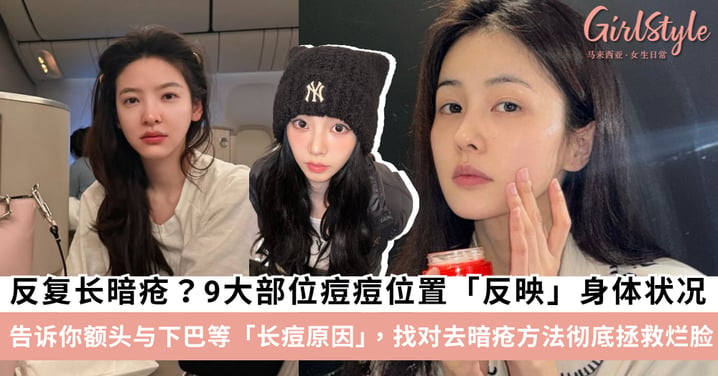 9大痘痘位置反映身体状况！深度剖析额头与下巴长痘原因，找对去暗疮方法彻底拯救烂脸～